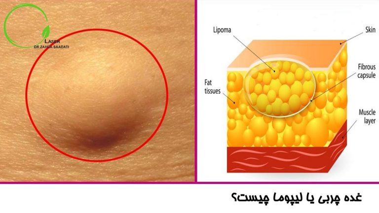 غده چربی یا لیپوم چیست