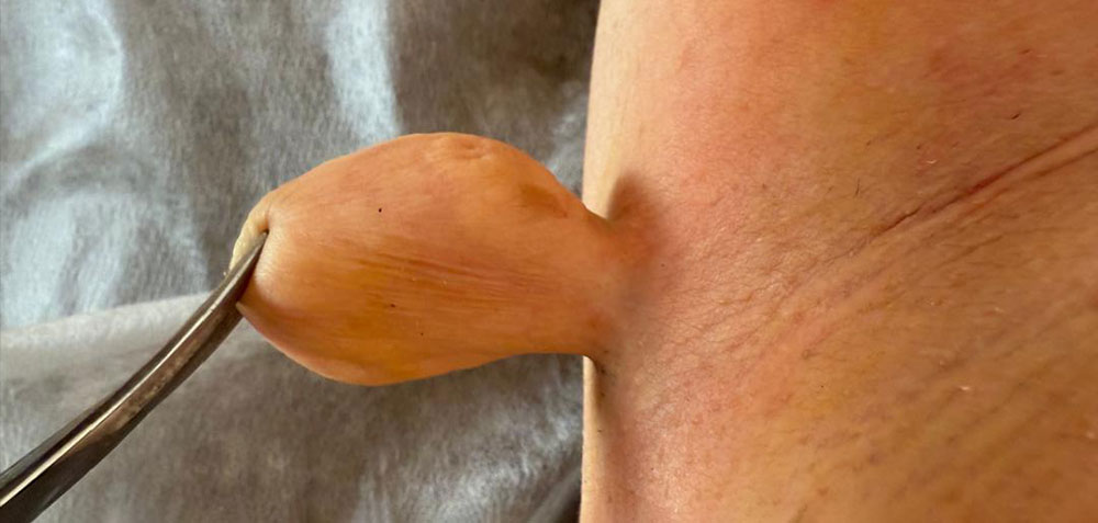 غده پوستی آویزان از زیر بغل بیمار