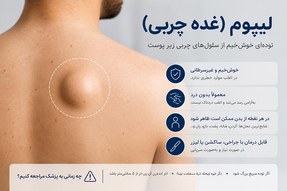 لیپوم یا غده چربی بدون درد و خوش خیم و قابل درمان با جراحی و ساکشن و یا لیزر