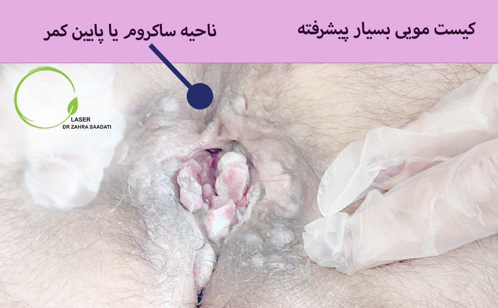 کیست مویی دنبالچه وخیم و پیشرفته که بر اثر عفونت شدید به بافت ناحیه آسیب وارد شده است