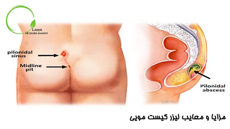 مزایا و معایب لیزر کیست مویی