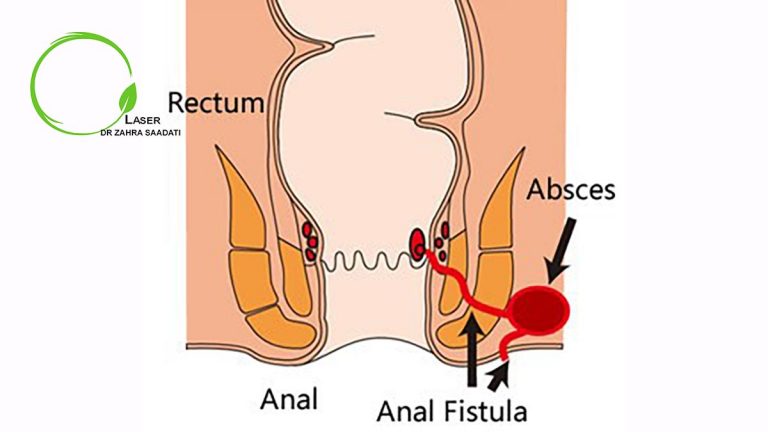 مقایسه لیزر فیستول با جراحی سنتی