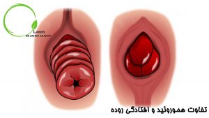 تفاوت بین هموروئید و افتادگی روده