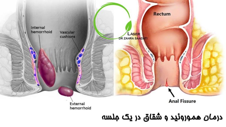 درمان هموروئید و شقاق در یک جلسه