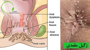 زگیل مقعدی