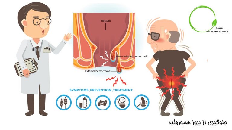 جلوگیری از هموروئید