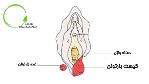 کیست بارتولن