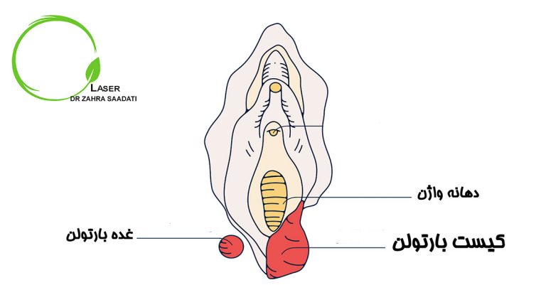 کیست بارتولن