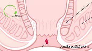 درمان گشادی مقعدی