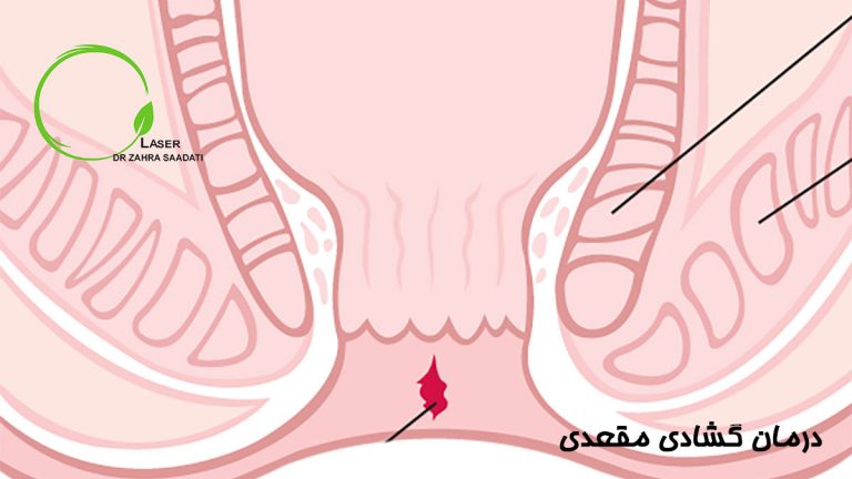 درمان گشادی مقعدی