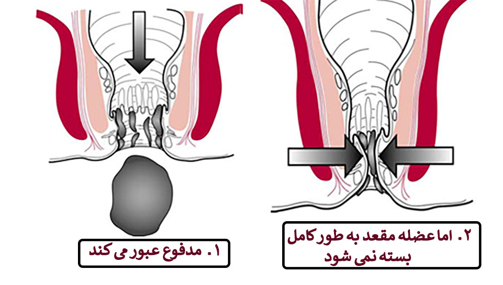 گشادی مقعد به دنبال دفع مدفوع و جمع نشدن عضله مقعد به دلیل شلی و ضعف عضلات