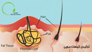 ترکیدن کیست مویی