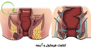 تفاوت بین فیستول و آبسه