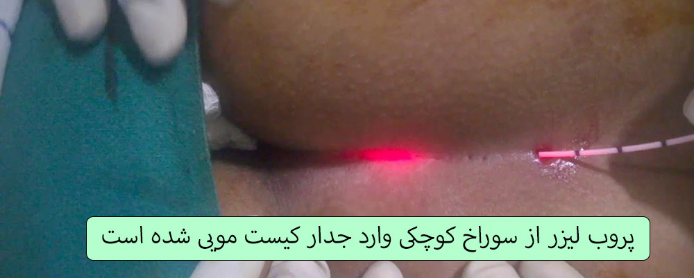 جراحی کیست مویی با لیزر پروب لیزر از سوراخ کوچکی وارد جدار کیست مویی شده است