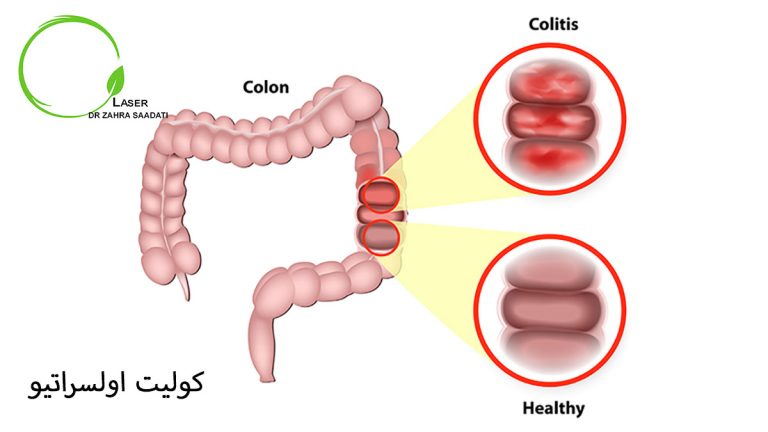 کولیت اولسراتیو