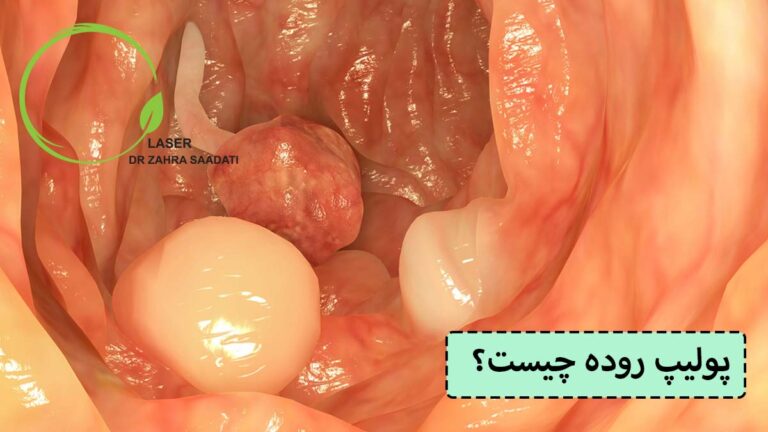 پولیپ روده چیست