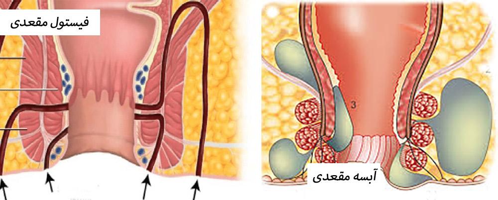 فیستول و آبسه مقعدی