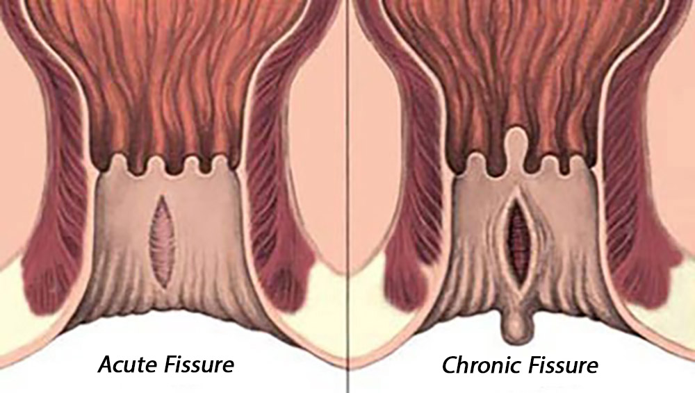 Types of fissures or anal fissures. The image on the left is acute fissure and the image on the right is chronic fissure