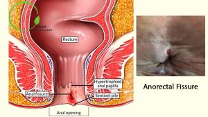 Anal fissure