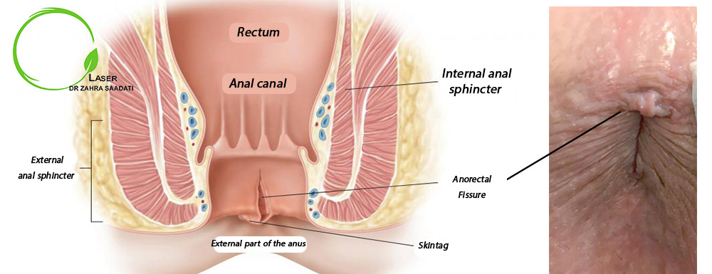 anorectal fissure diagnosis