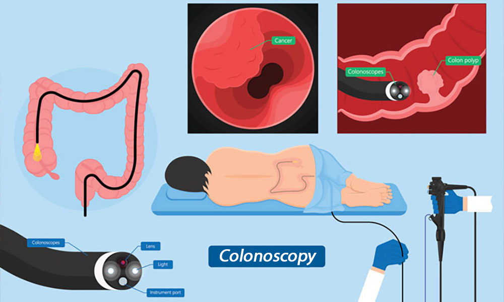 Colonoscopy to diagnose hemorrhoids