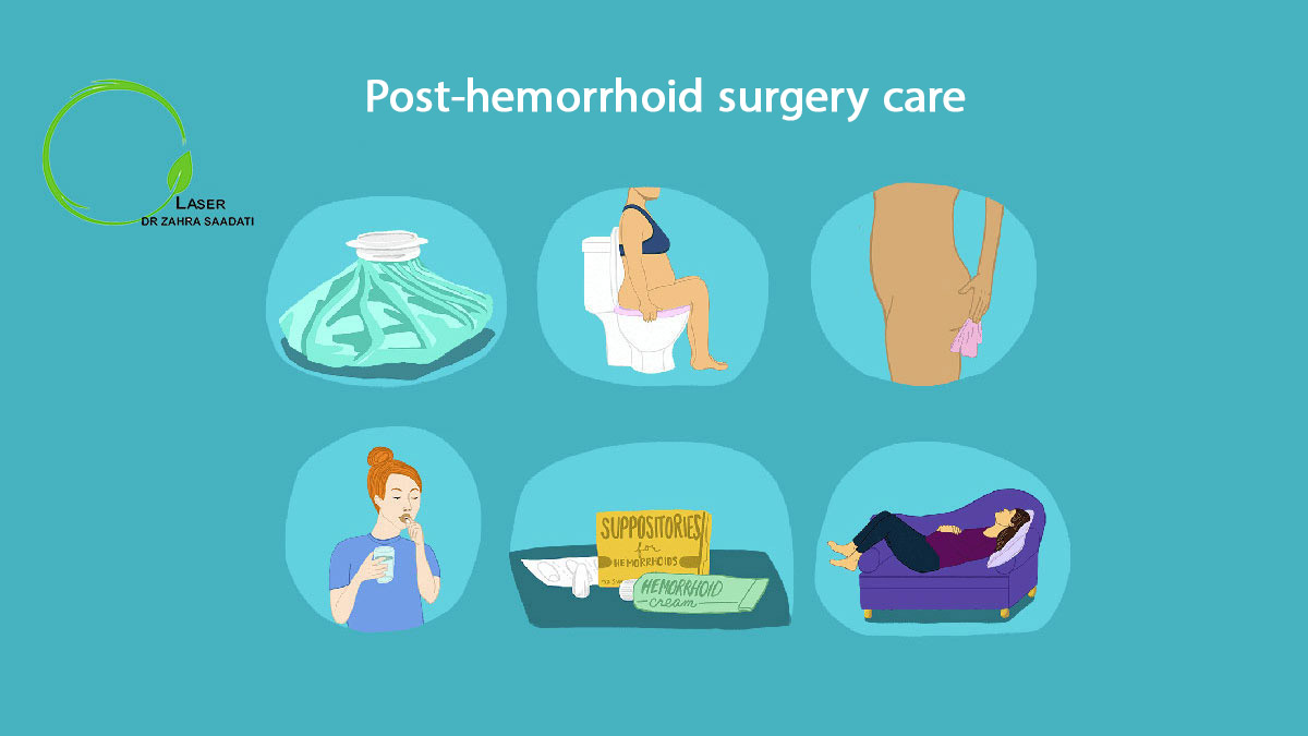 Post-Hemorrhoid Surgery Care