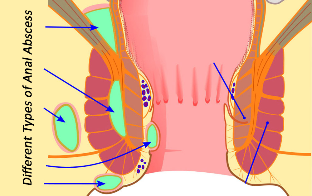 different types of anal abscess