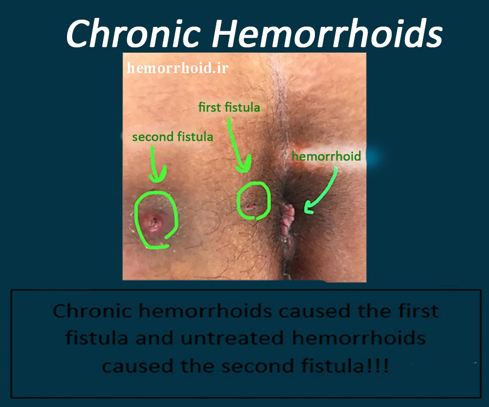 Images of hemorrhoids or piles - Dr. Zahra Saadati Laser Surgery