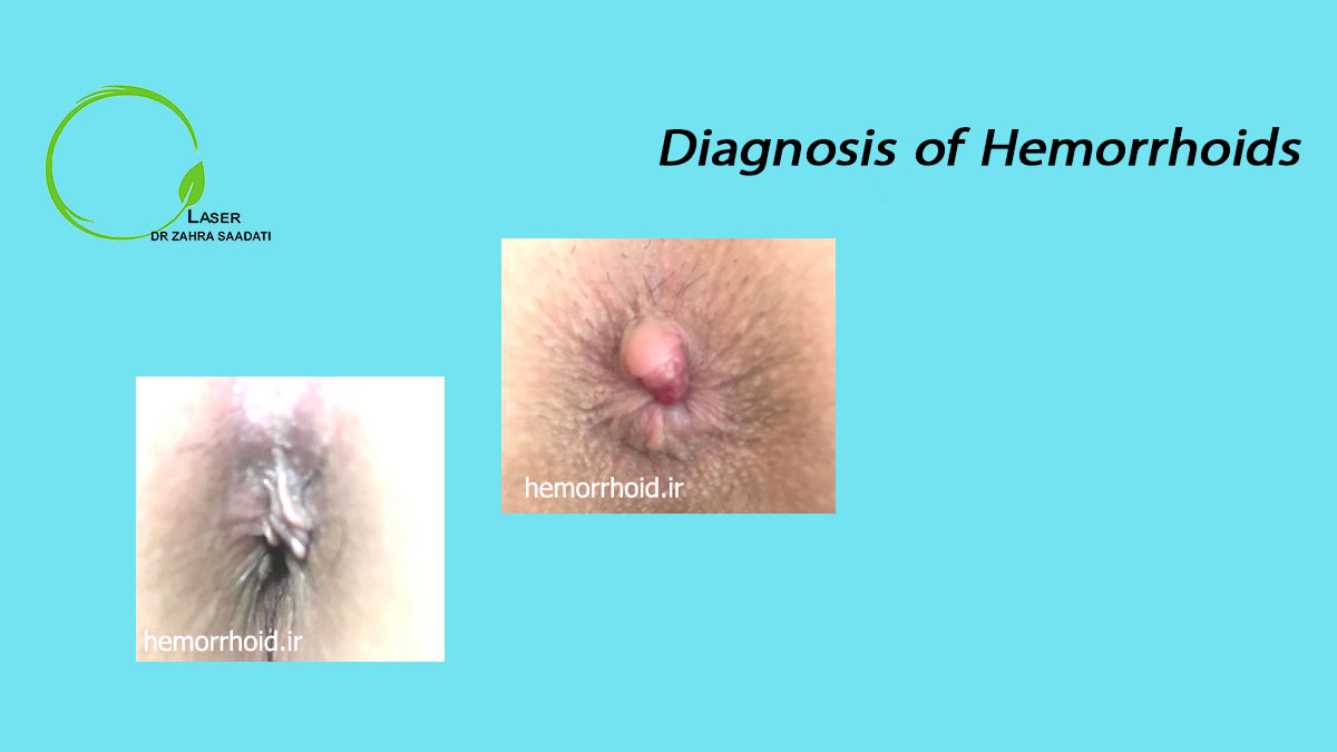 Diagnosis of Hemorrhoids