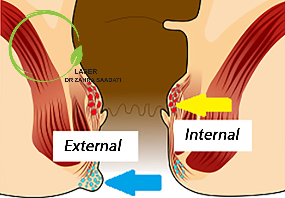 internal and external hemorrhoid
