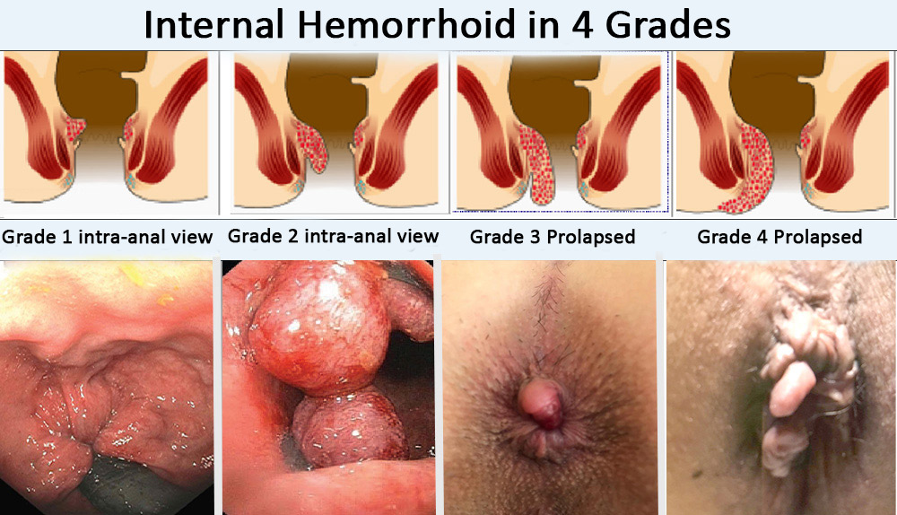 Grades of internal hemorrhoids in four main grades