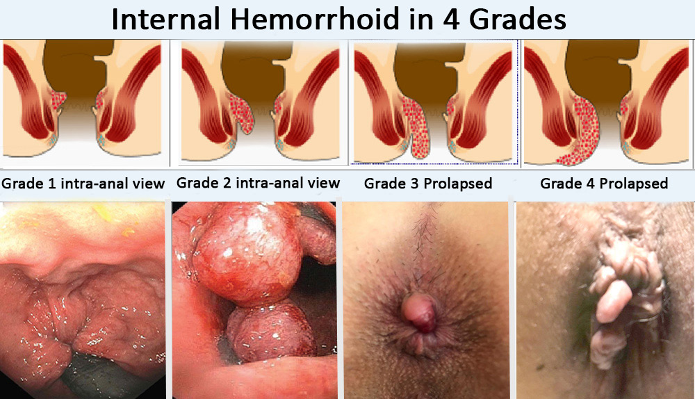 prolapsed hemorrhoid vs external