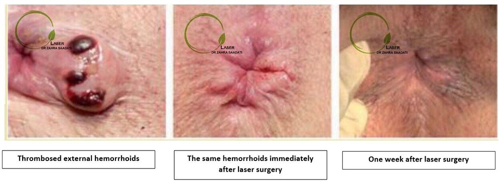 hemorrhoid laser before after