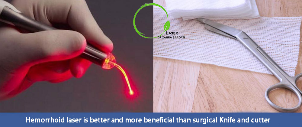 Hemorrhoid laser is better and more beneficial than surgical Knife and cutter