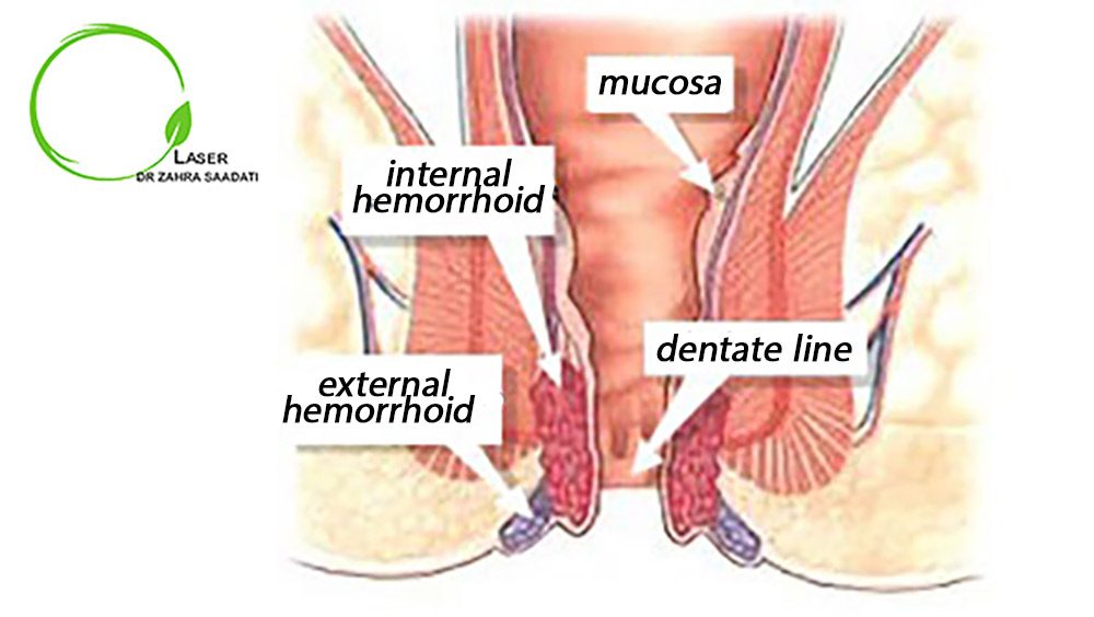 hemorrhoid or piles anatomy