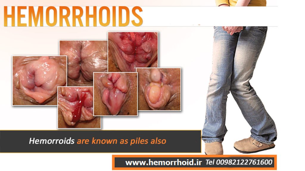 Images of hemorrhoids or piles