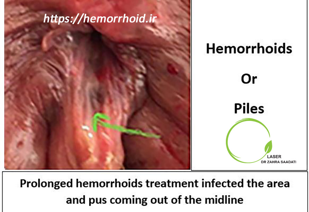 Images of hemorrhoids or piles - Dr. Zahra Saadati Laser Surgery