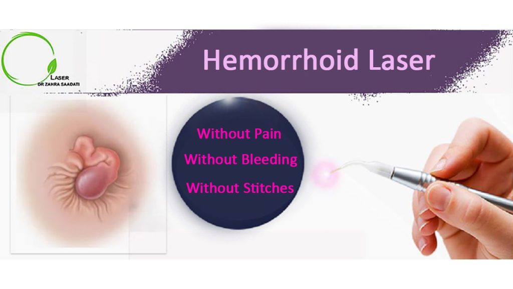 Hemorrhoid Laser