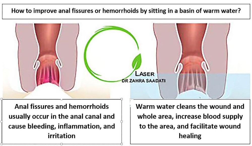 How does warm water relieve hemorrhoids