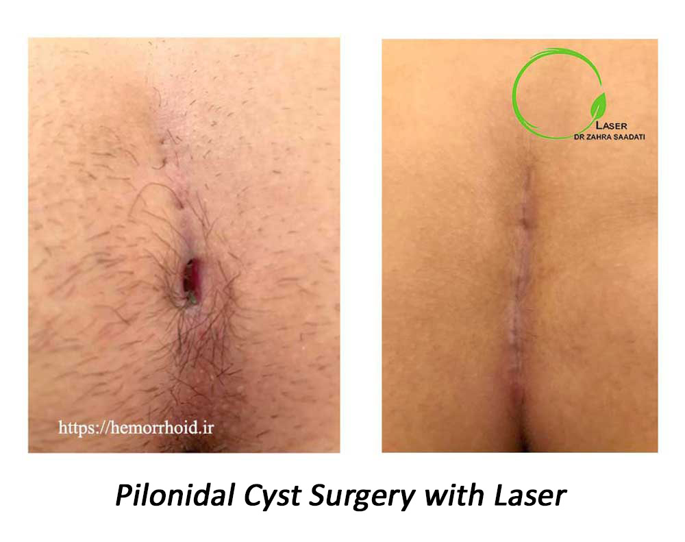 Photo of before and after pilonidal cyst laser surgery