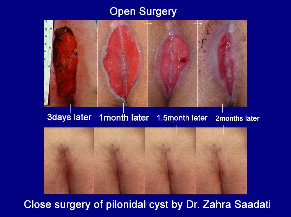 pilonidal sinus comparison open surgery and laser