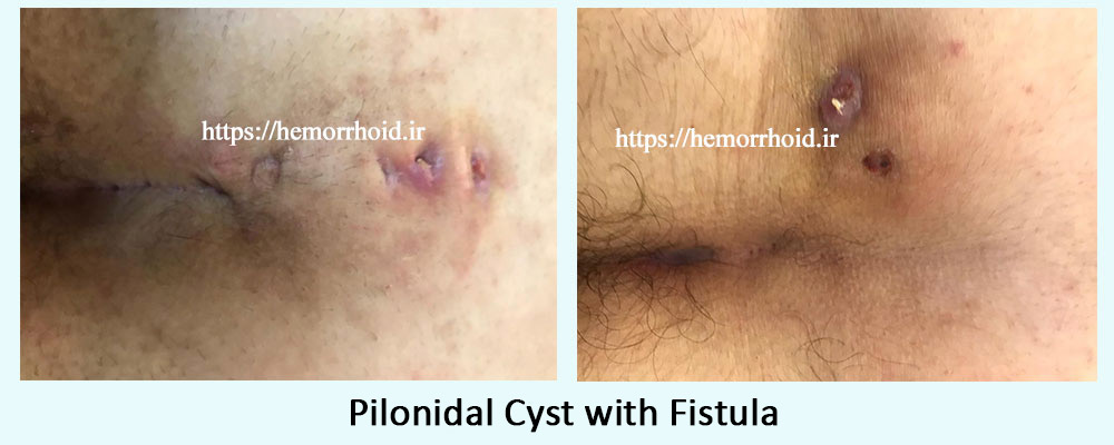 Diagnosing pilonidal cyst Image of two cases of pilonidal cyst with fistula
