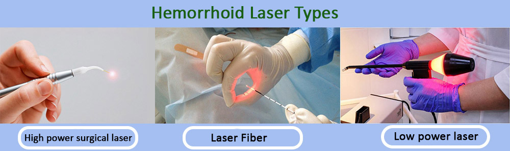 types of hemorrhoid laser