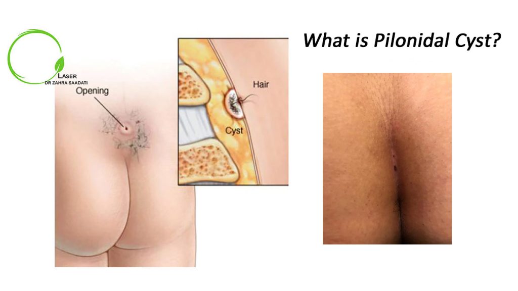what is pilonidal cyst