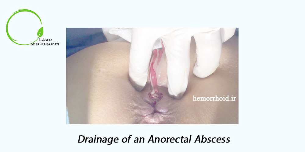 Drainage of an anorectal abscess in a surgical center