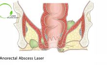 Images of hemorrhoids or piles - Dr. Zahra Saadati Laser Surgery