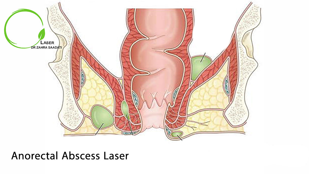 Anorectal Abscess Laser