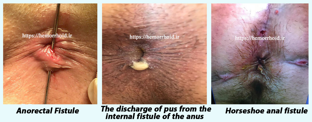 anorectal fistule diagnosis in 3 grade