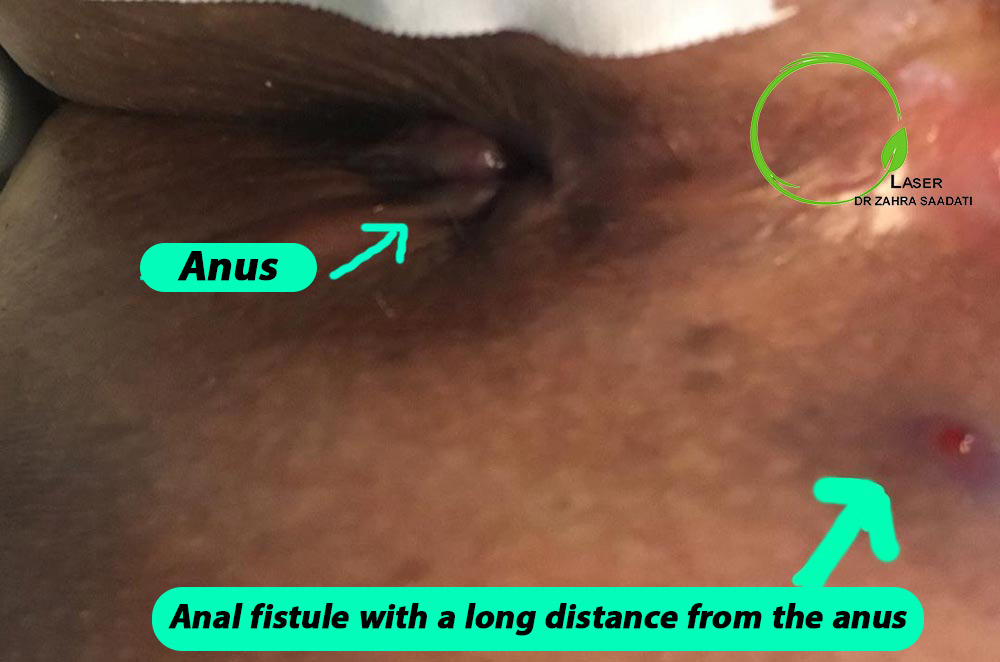 Anal fistule with a long distance from the anus