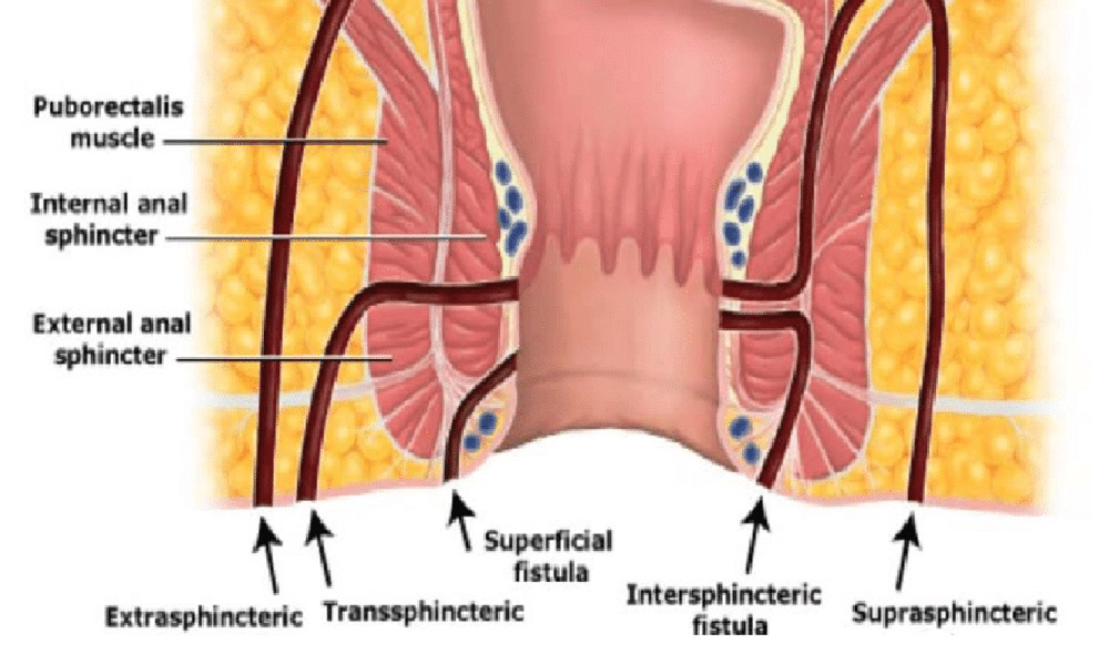 anorectal fistule types